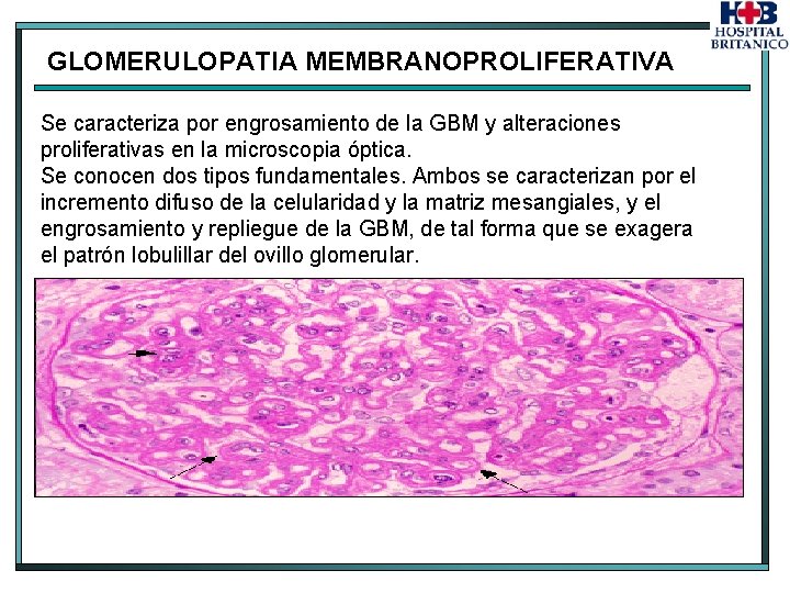 GLOMERULOPATIA MEMBRANOPROLIFERATIVA Se caracteriza por engrosamiento de la GBM y alteraciones proliferativas en la