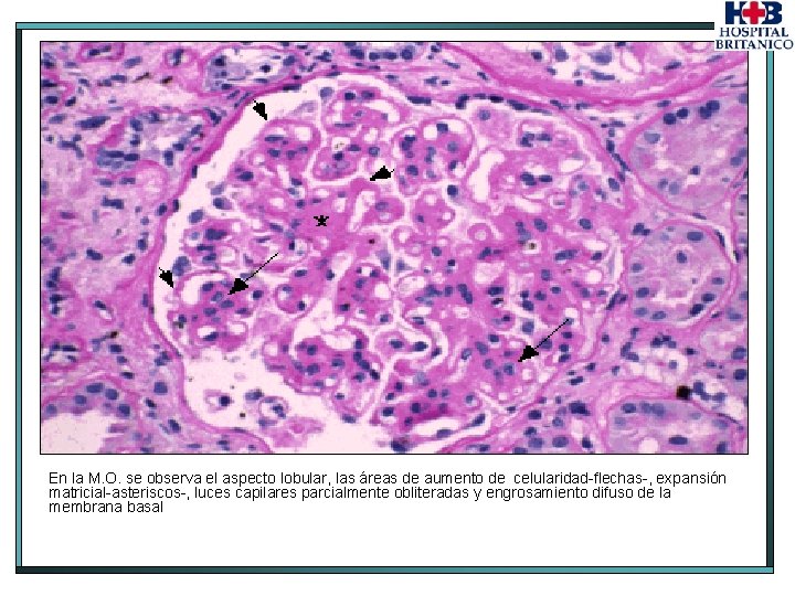 En la M. O. se observa el aspecto lobular, las áreas de aumento de