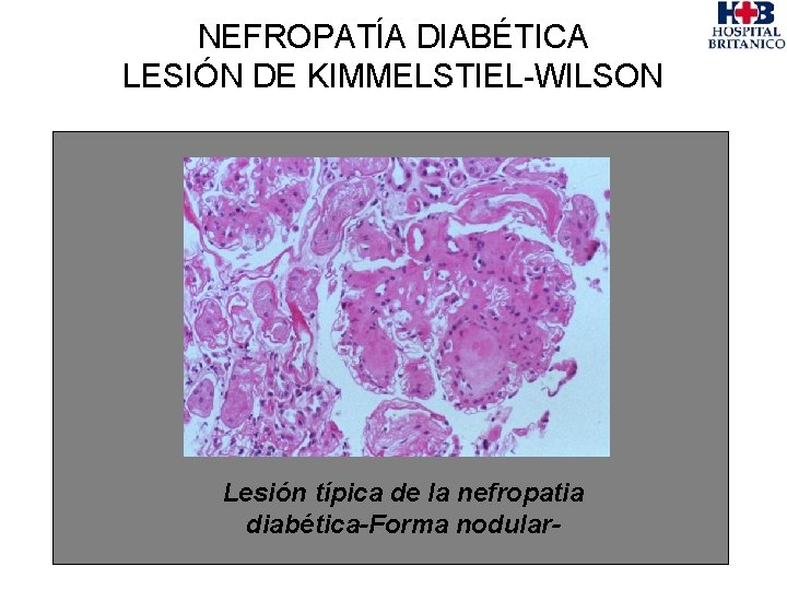 NEFROPATÍA DIABÉTICA LESIÓN DE KIMMELSTIEL-WILSON Lesión típica de la nefropatia diabética-Forma nodular- 
