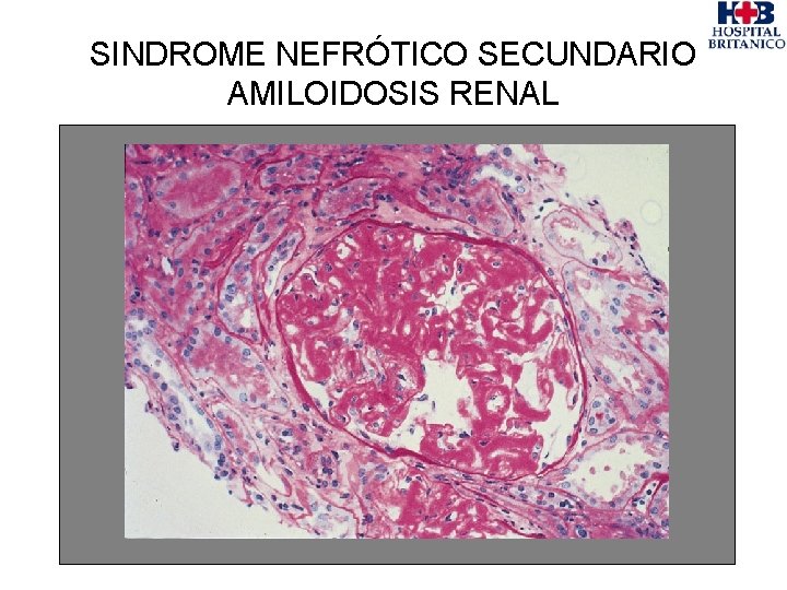 SINDROME NEFRÓTICO SECUNDARIO AMILOIDOSIS RENAL 