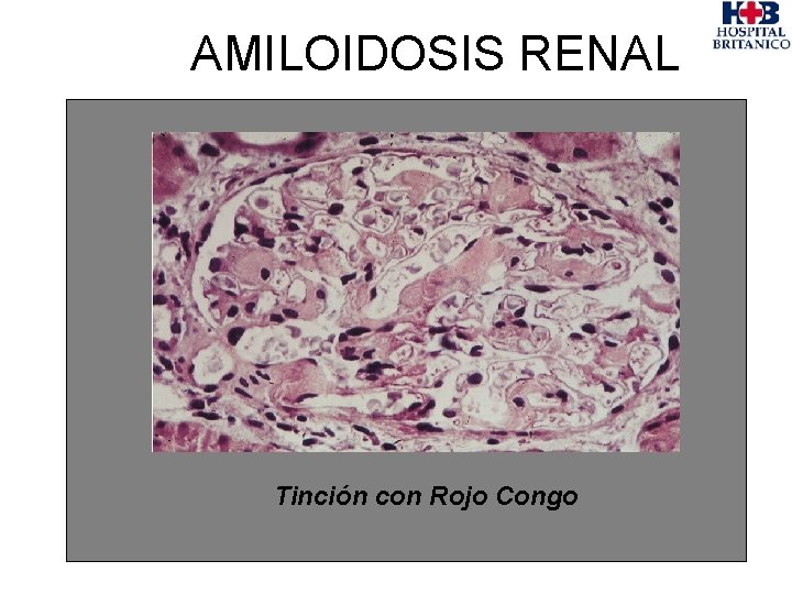 AMILOIDOSIS RENAL Tinción con Rojo Congo 