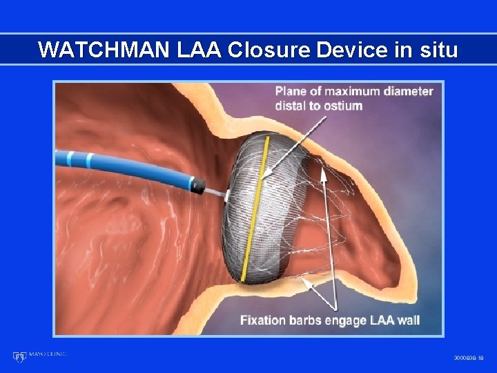 WATCHMAN LAA Closure Device in situ 3000838 -18 