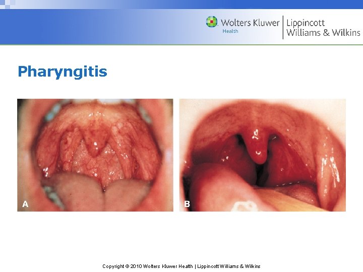 Pharyngitis Copyright © 2010 Wolters Kluwer Health | Lippincott Williams & Wilkins 