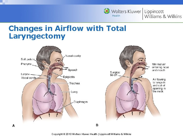 Changes in Airflow with Total Laryngectomy Copyright © 2010 Wolters Kluwer Health | Lippincott