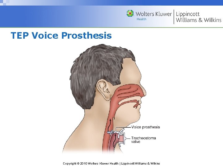 TEP Voice Prosthesis Copyright © 2010 Wolters Kluwer Health | Lippincott Williams & Wilkins