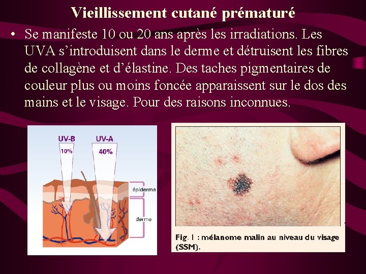 Vieillissement cutané prématuré • Se manifeste 10 ou 20 ans après les irradiations. Les