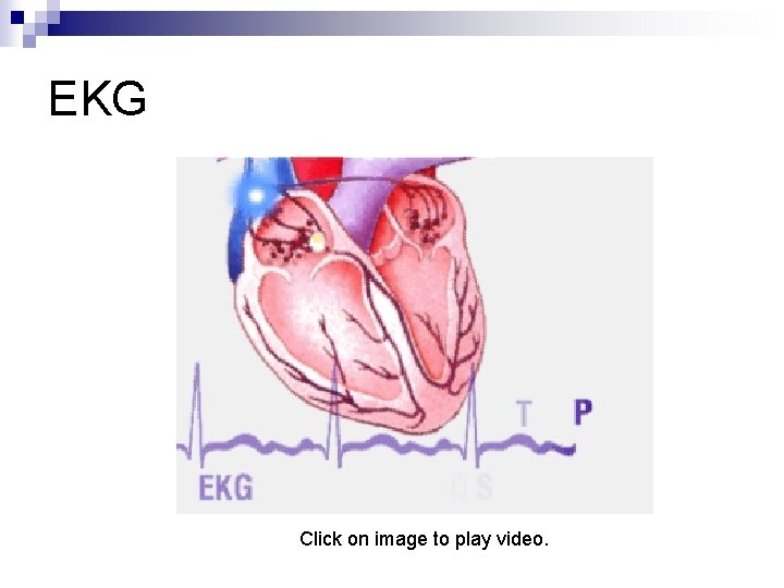 EKG Click on image to play video. 