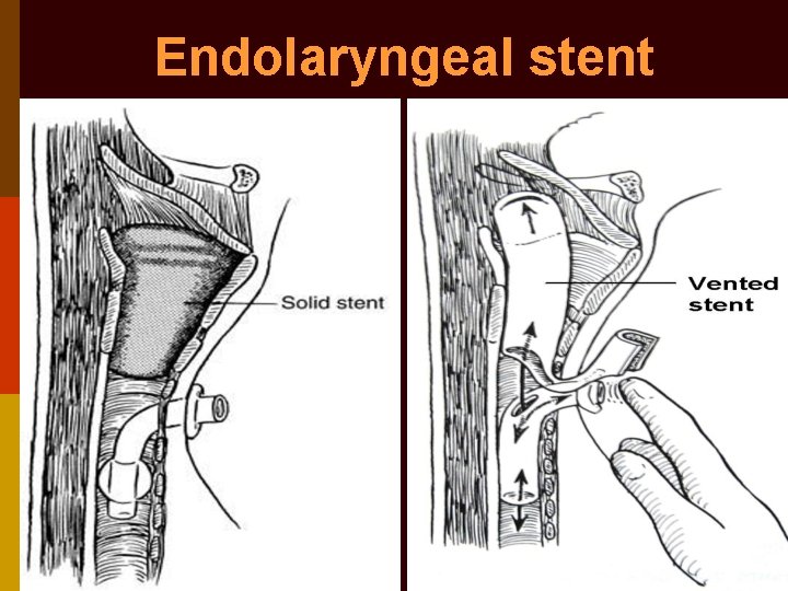 Endolaryngeal stent 
