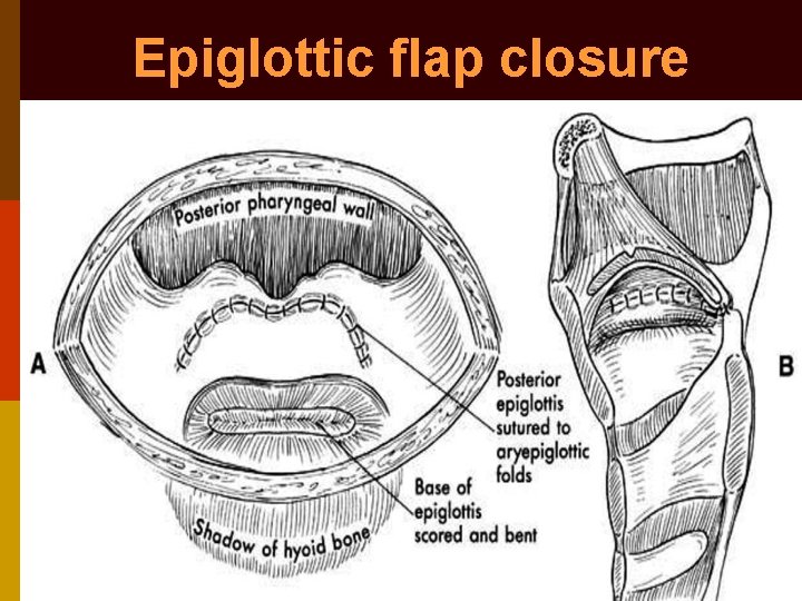 Epiglottic flap closure 