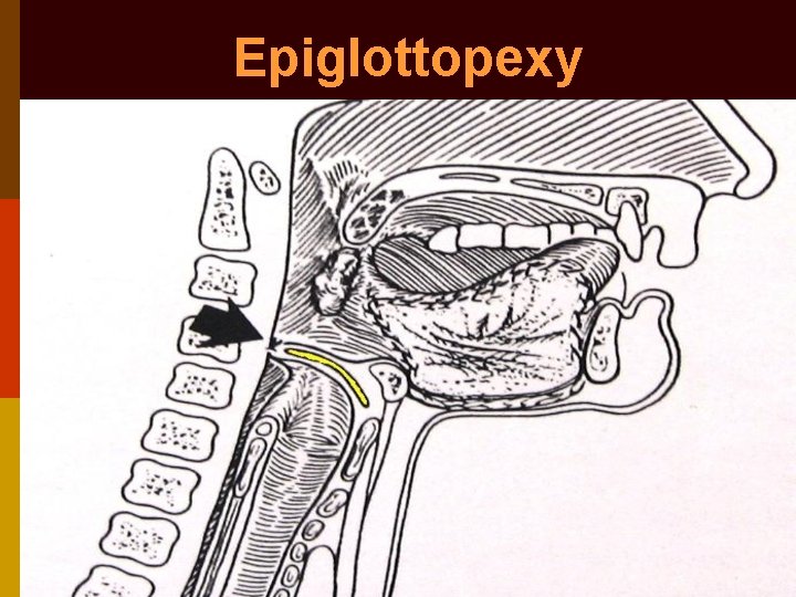Vocal cord palsy evaluation of hoarseness Dr Vishal