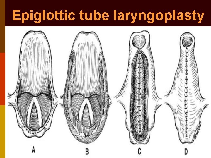 Epiglottic tube laryngoplasty 