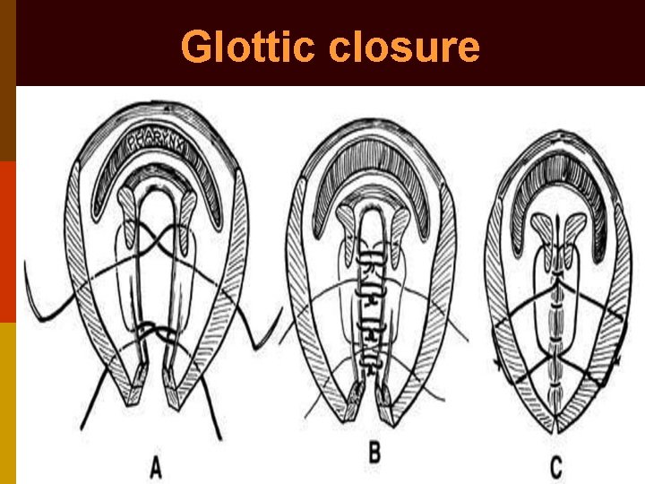 Glottic closure 