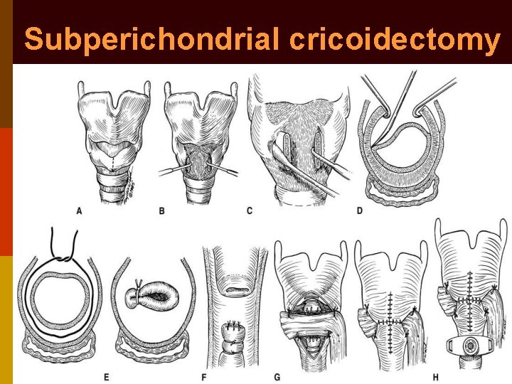 Subperichondrial cricoidectomy 