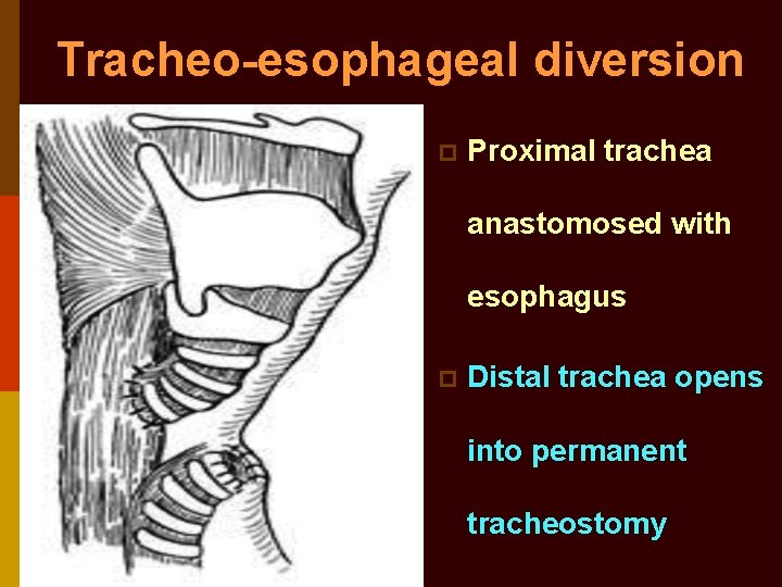 Tracheo-esophageal diversion p Proximal trachea anastomosed with esophagus p Distal trachea opens into permanent