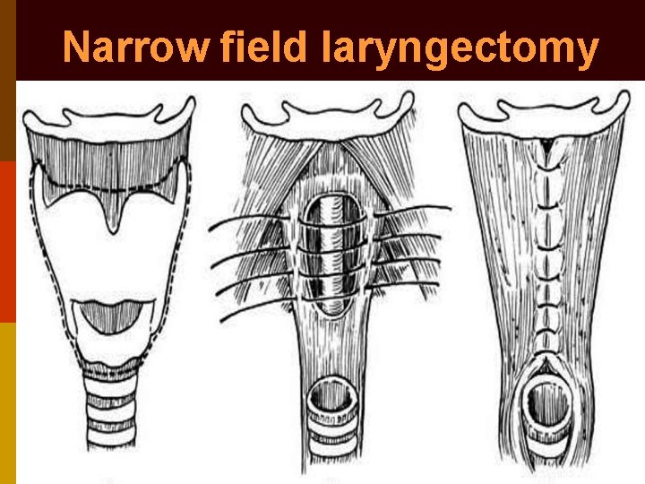 Narrow field laryngectomy 