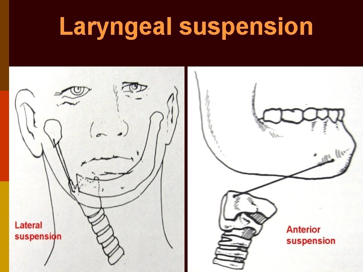 Laryngeal suspension 