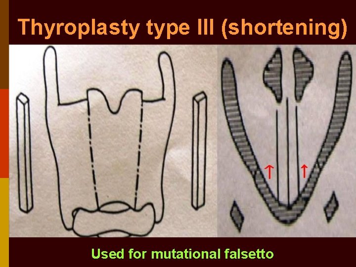 Thyroplasty type III (shortening) Used for mutational falsetto 