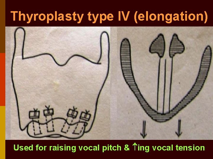 Thyroplasty type IV (elongation) Used for raising vocal pitch & ing vocal tension 