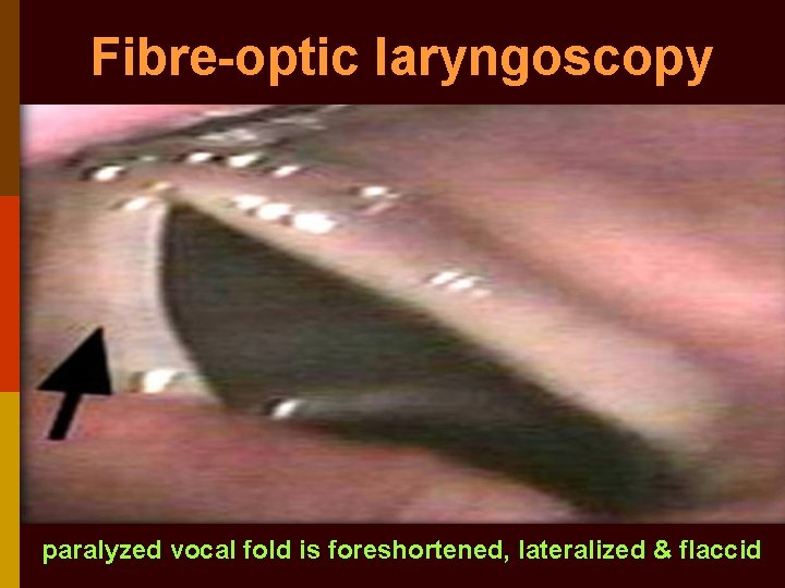 Fibre-optic laryngoscopy paralyzed vocal fold is foreshortened, lateralized & flaccid 