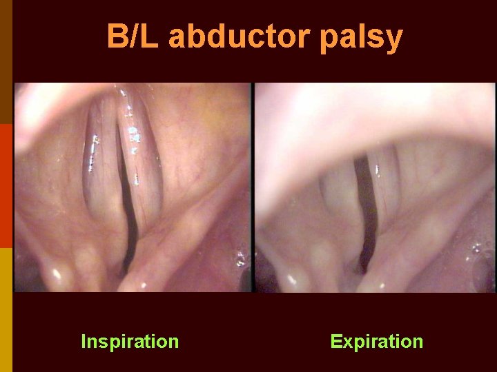B/L abductor palsy Inspiration Expiration 