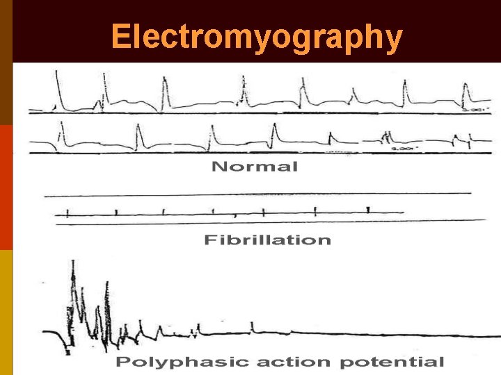 Electromyography 