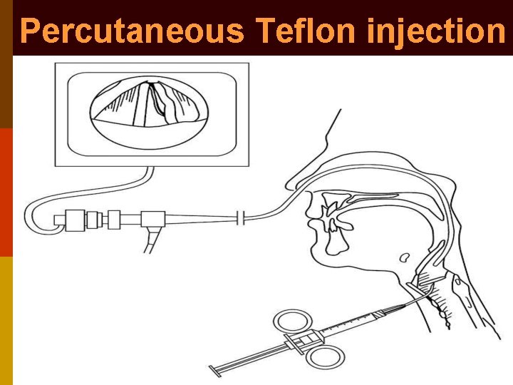 Percutaneous Teflon injection 