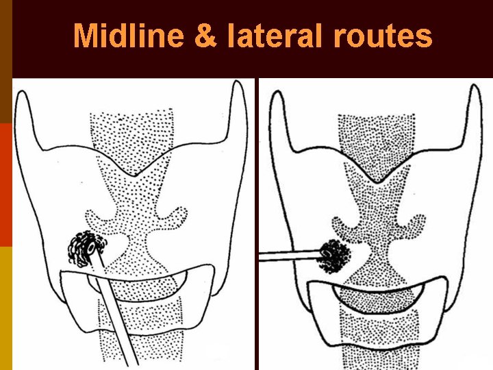 Midline & lateral routes 