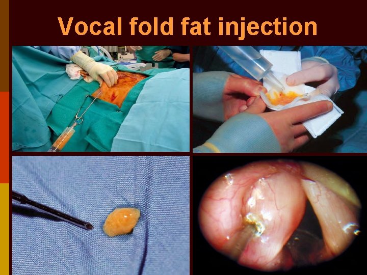 Vocal fold fat injection 
