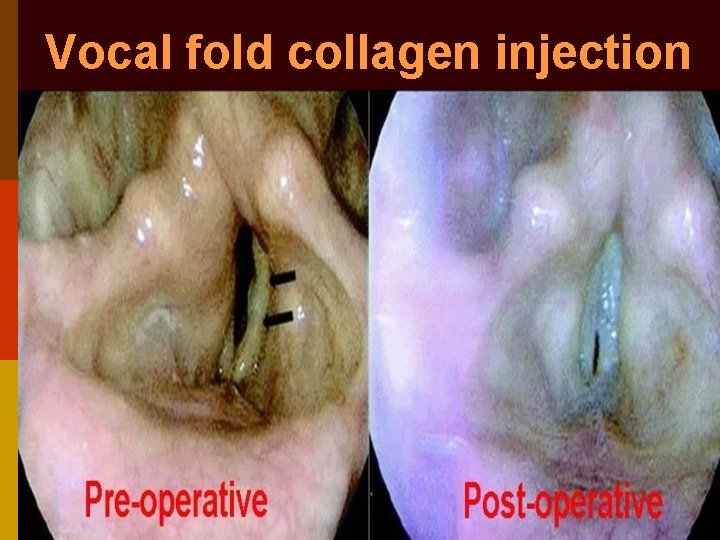 Vocal fold collagen injection 
