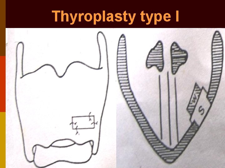 Thyroplasty type I 