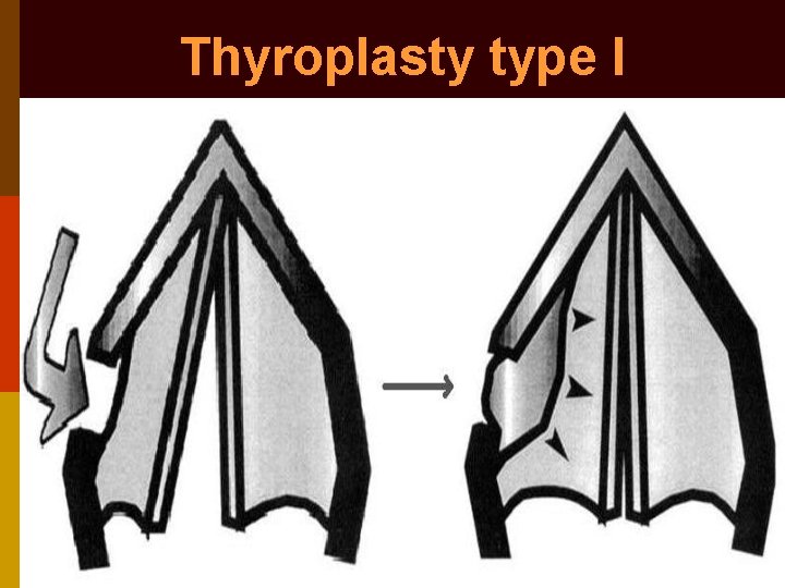 Thyroplasty type I 