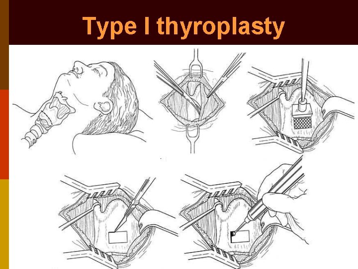 Type I thyroplasty 