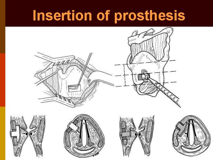 Insertion of prosthesis 
