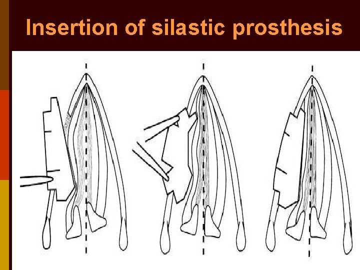 Insertion of silastic prosthesis 