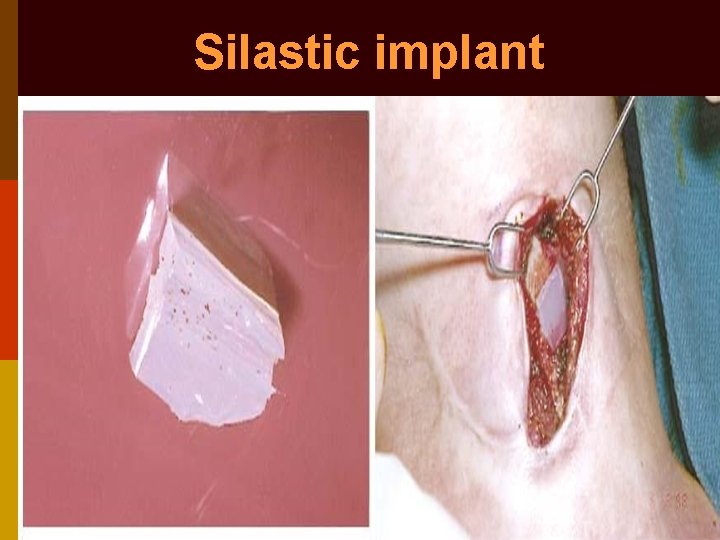 Silastic implant 