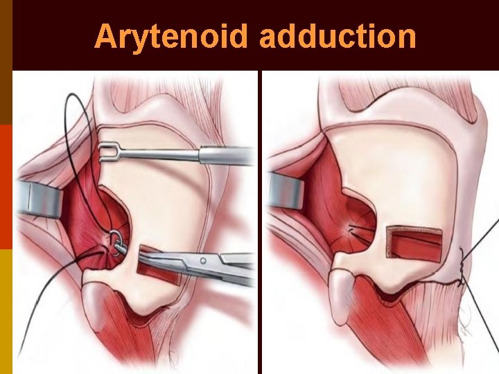 Arytenoid adduction 