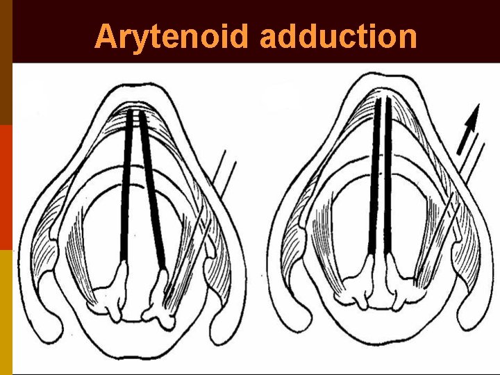 Arytenoid adduction 