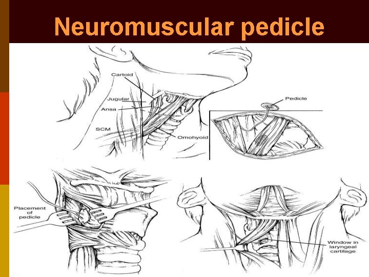 Neuromuscular pedicle 