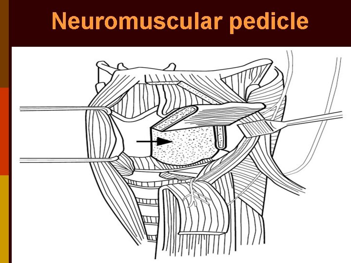 Neuromuscular pedicle 