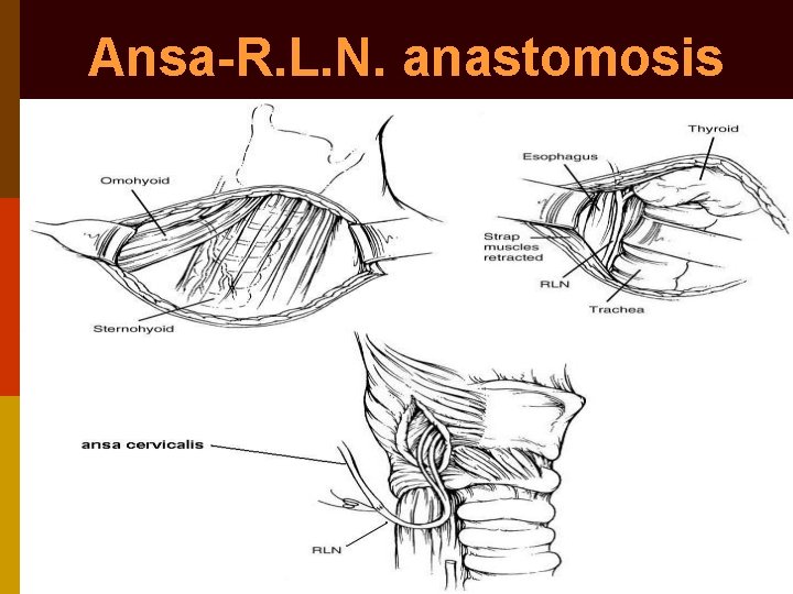 Vocal Cord Palsy Evaluation Of Hoarseness Dr Vishal