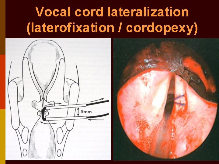 Vocal cord lateralization (laterofixation / cordopexy) 