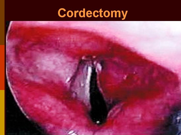 Cordectomy 