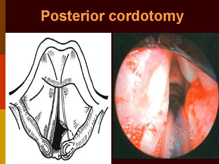 Posterior cordotomy 