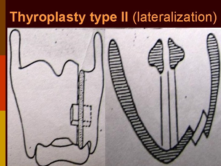 Thyroplasty type II (lateralization) 