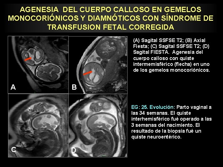 AGENESIA DEL CUERPO CALLOSO EN GEMELOS MONOCORIÓNICOS Y DIAMNÓTICOS CON SÍNDROME DE TRANSFUSION FETAL