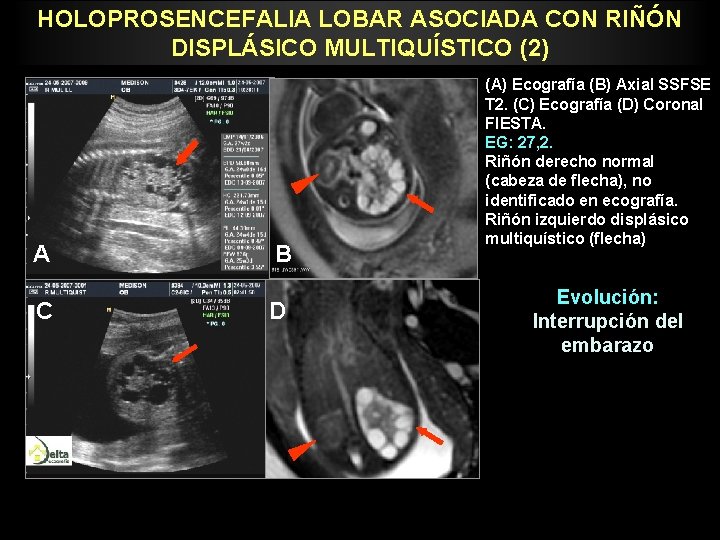 HOLOPROSENCEFALIA LOBAR ASOCIADA CON RIÑÓN DISPLÁSICO MULTIQUÍSTICO (2) A B C D (A) Ecografía