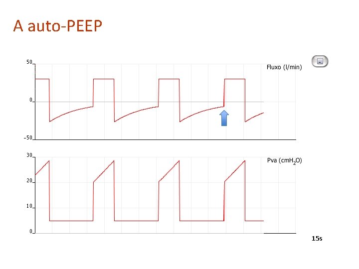 A auto-PEEP 