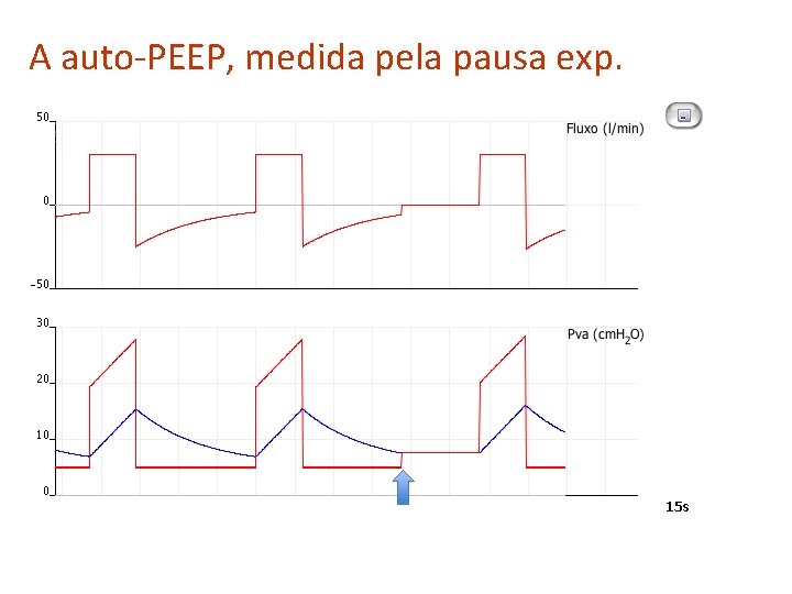 A auto-PEEP, medida pela pausa exp. 