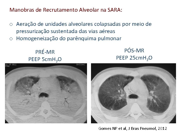 Manobras de Recrutamento Alveolar na SARA: o Aeração de unidades alveolares colapsadas por meio