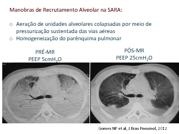 Manobras de Recrutamento Alveolar na SARA: o Aeração de unidades alveolares colapsadas por meio